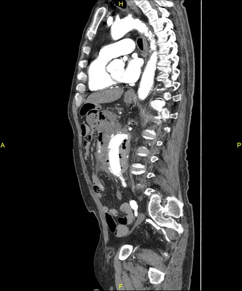 File:Aortoenteric fistula (Radiopaedia 84308-99603 C 202).jpg