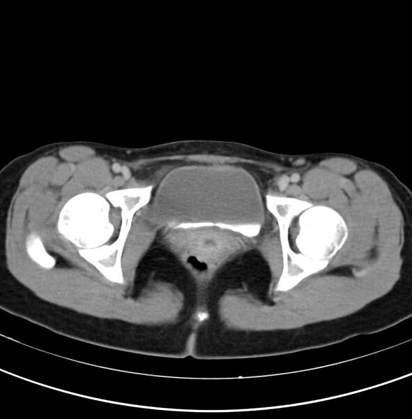File:Appendicitis and incidental bicornuate uterus (Radiopaedia 22833-22853 Axial C+ delayed 39).jpg