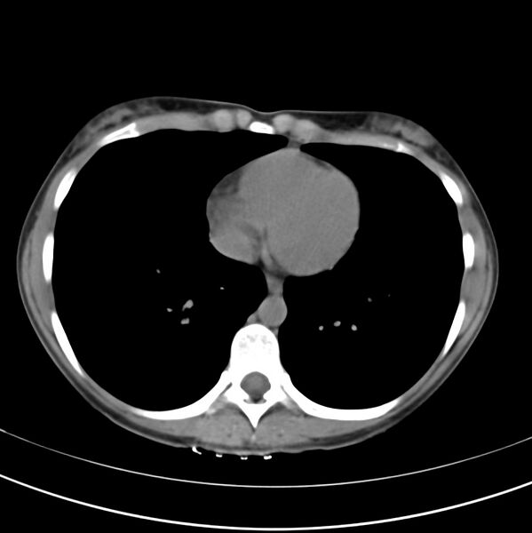 File:Appendicitis and incidental bicornuate uterus (Radiopaedia 22833-22853 Axial non-contrast 1).jpg