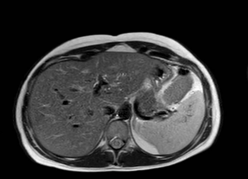 File:Appendicitis in gravida (MRI) (Radiopaedia 89433-106395 Axial T2 11).jpg