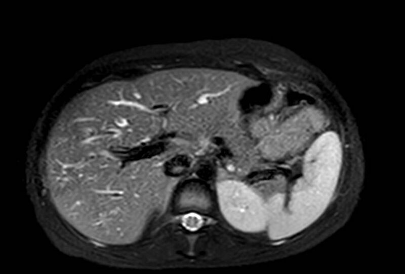 File:Appendicitis in gravida (MRI) (Radiopaedia 89433-106395 Axial T2 SPAIR 18).jpg