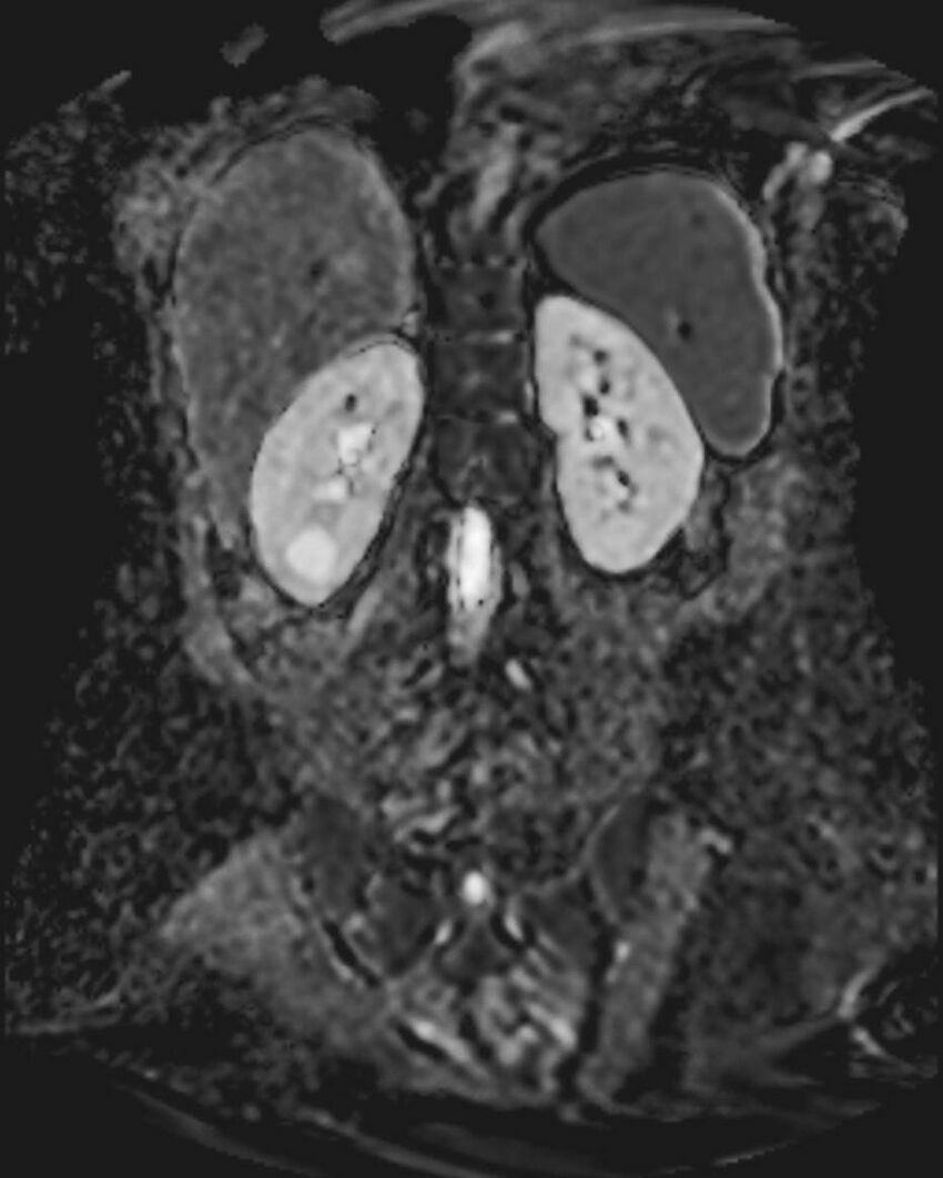 Appendicitis in gravida (MRI) (Radiopaedia 89433-106395 Coronal ADC 43).jpg