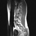Arachnoid cyst - spinal (Radiopaedia 66835-76157 Sagittal T1 1).jpg
