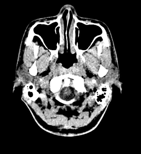 File:Arachnoid cyst of the ambient cistern (Radiopaedia 81301-94986 Axial non-contrast 2).jpg