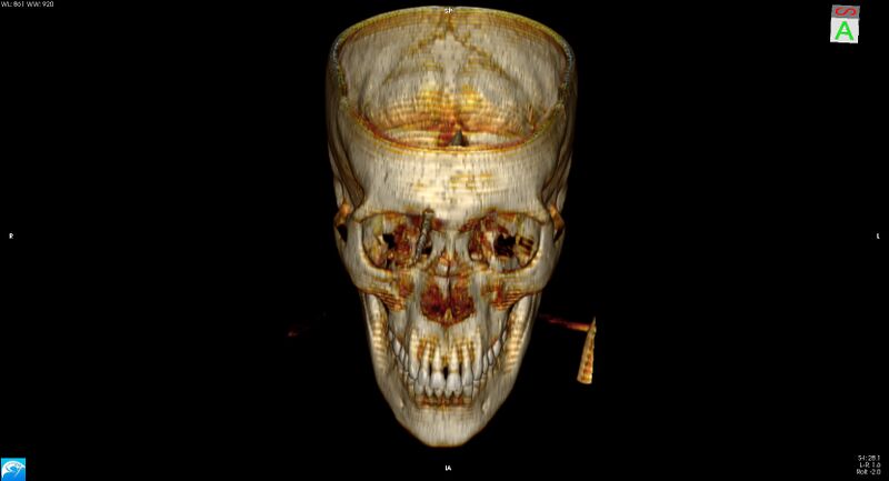 File:Arrow injury to the brain (Radiopaedia 72101-82607 3D bone 8).jpg