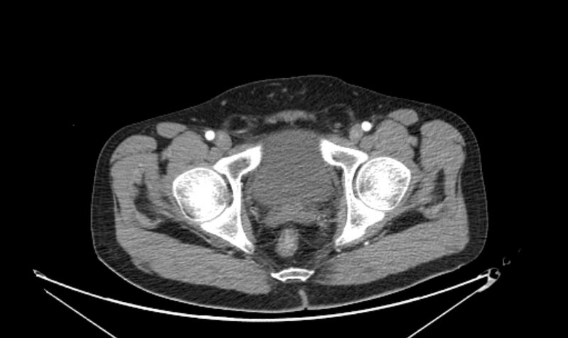 File:Arterial occlusive mesenteric ischemia (Radiopaedia 84641-100060 A 125).jpg