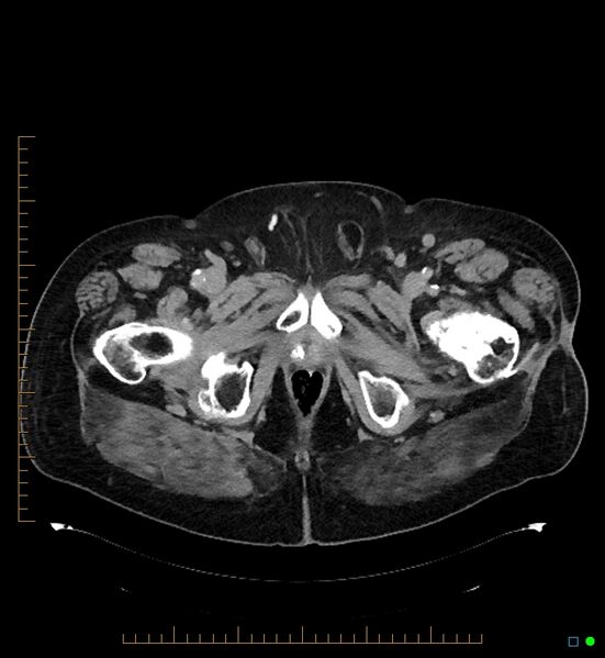 File:Artificial urethral sphincter (Radiopaedia 46937-51464 A 11).jpg