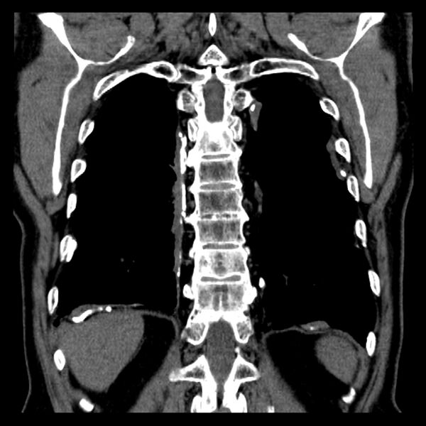 File:Asbestos-related pleural plaques (Radiopaedia 39069-41255 Coronal non-contrast 16).jpg