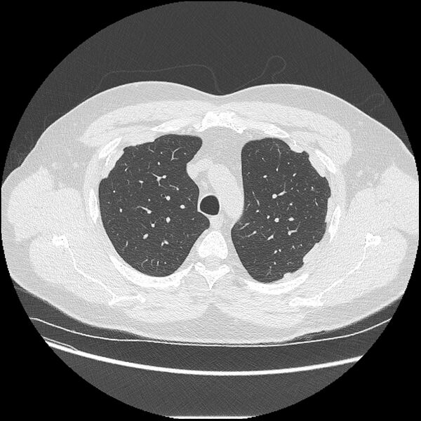 File:Asbestosis (Radiopaedia 45002-48961 Axial lung window 13).jpg