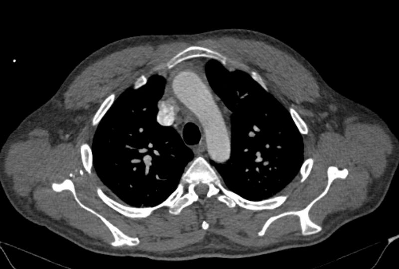 File:Ascending aortic aneurysm (Radiopaedia 86279-102297 C 14).jpg