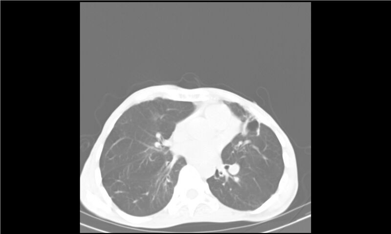 File:Aspergilloma (Radiopaedia 20788-20701 Axial lung window 20).jpg