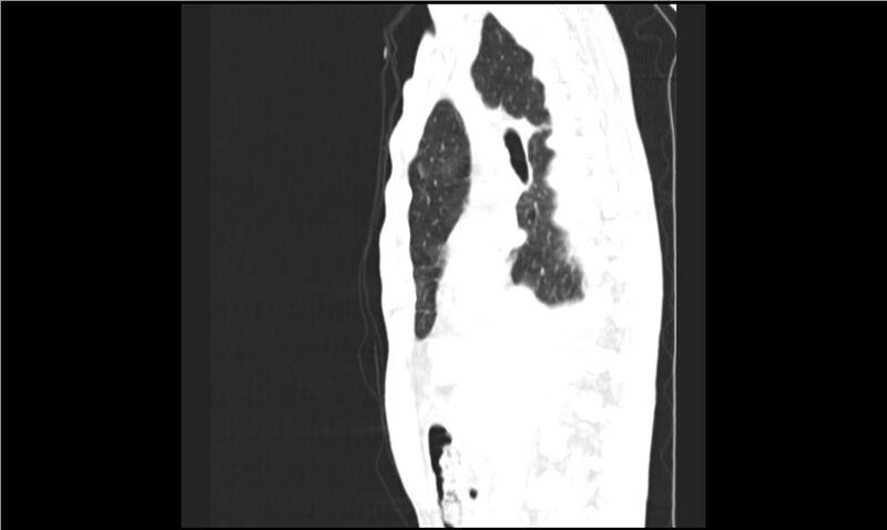 File:Aspergilloma (Radiopaedia 20788-20701 Sagittal lung window 12).jpg