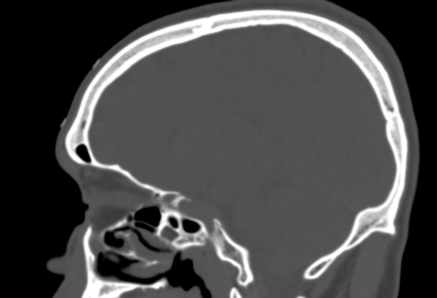 Asymptomatic occipital spur (Radiopaedia 87753-104201 Sagittal bone window 183).jpg