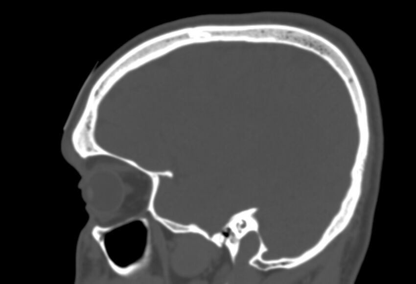 Asymptomatic occipital spur (Radiopaedia 87753-104201 Sagittal bone window 79).jpg