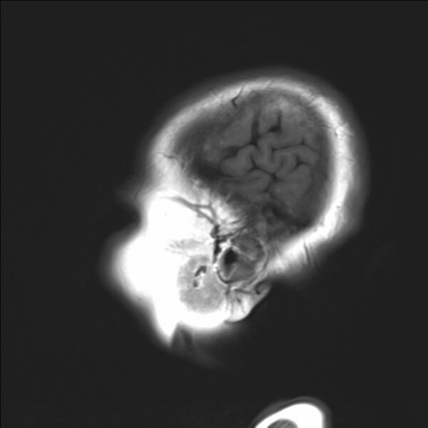 File:Atlanto-occipital assimilation with basilar invagination (Radiopaedia 70122-80157 Sagittal T1 23).jpg