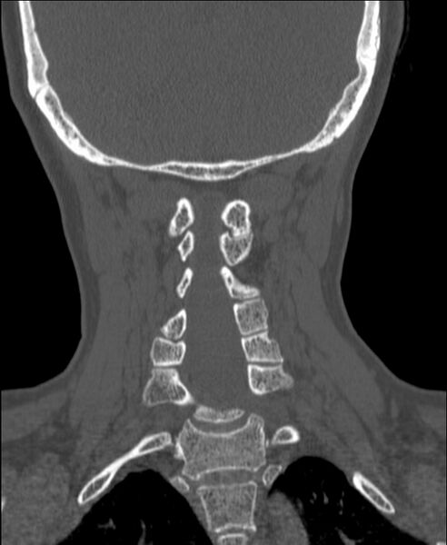 File:Atlanto-occipital assimilation with basilar invagination (Radiopaedia 70122-80188 Coronal bone window 150).jpg