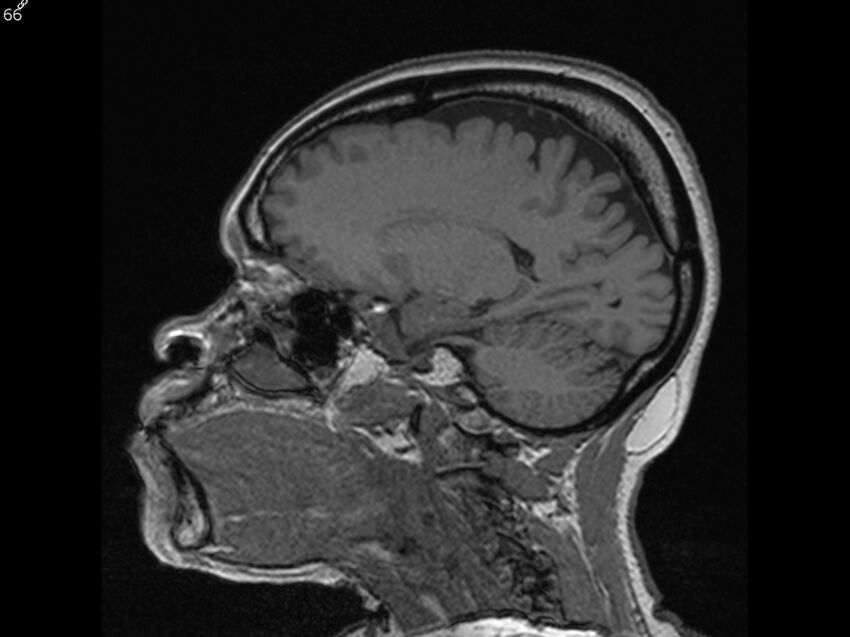 Atypical meningioma - intraosseous (Radiopaedia 64915-74572 Sagittal T1 66).jpg