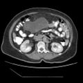 Atypical retroperitoneal lymphocoeles with large leiomyoma of uterus (Radiopaedia 32084-33024 A 18).jpg