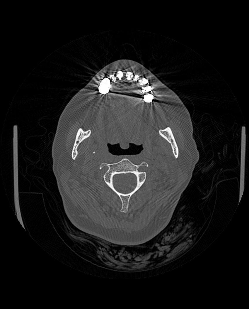 Automastoidectomy with labyrinthine fistula (Radiopaedia 84143-99411 Axial non-contrast 12).jpg
