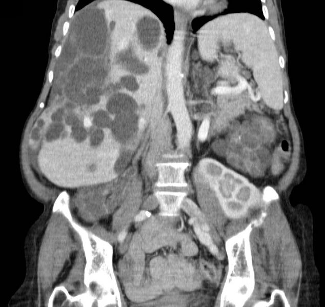 File:Autosomal dominant polycystic kidney disease (Radiopaedia 16777-16490 B 27).jpg
