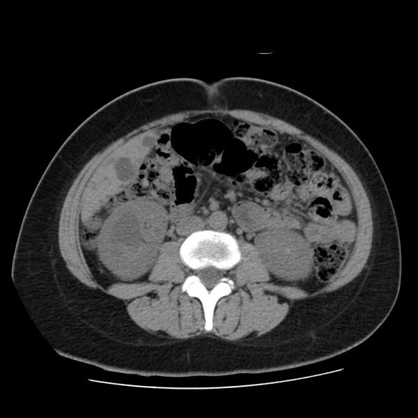 File:Autosomal dominant polycystic kidney disease (Radiopaedia 23061-23093 Axial non-contrast 35).jpg