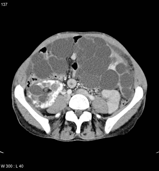File:Autosomal dominant polycystic kidney disease with extensive hepatic involvement (Radiopaedia 5204-6971 B 19).jpg