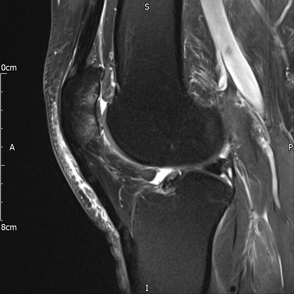 File:Avulsion fracture of the fibular head (Radiopaedia 74804-85808 Sagittal PD fat sat 20).jpg