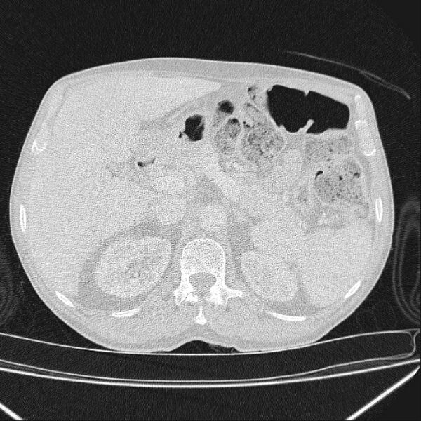 File:Azygos lobe (Radiopaedia 38259-40275 Axial lung window 89).jpg