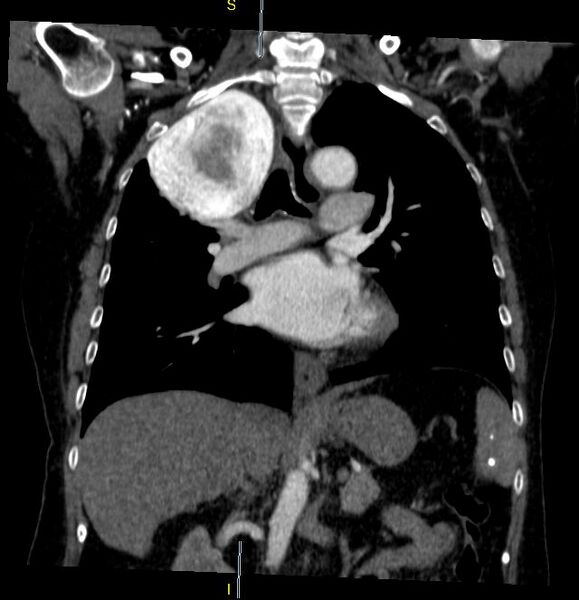 File:Azygos vein aneurysm (Radiopaedia 77824-90130 C 19).JPG