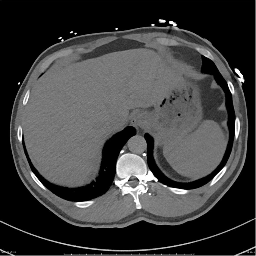 Azygos venous system anatomy (CT pulmonary angiography) (Radiopaedia 25928-26077 Axial C+ CTPA 79).jpg