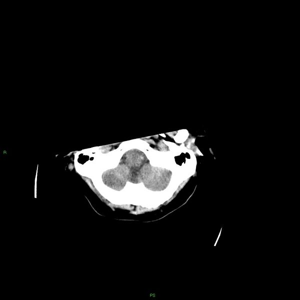 File:Basal ganglia hemorrhage (Radiopaedia 58349-65472 Axial non-contrast 51).jpg