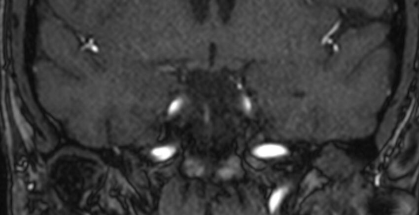 Basilar artery fenestration (Radiopaedia 74537-85455 Coronal MRA TOF 29).jpg