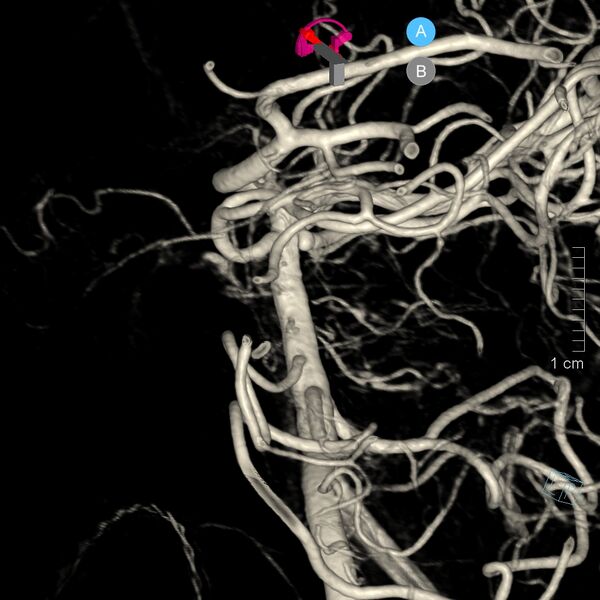 File:Basilar artery perforator aneurysm (Radiopaedia 82455-97734 3D view left VA 10).jpg