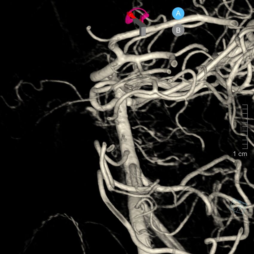 Basilar artery perforator aneurysm (Radiopaedia 82455-97734 3D view left VA 10).jpg
