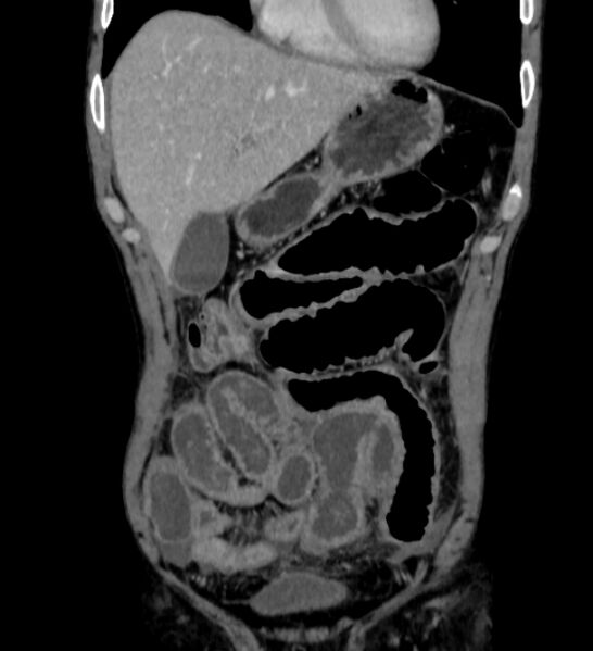 File:Behçet's disease- abdominal vasculitis (Radiopaedia 55955-62570 B 10).jpg