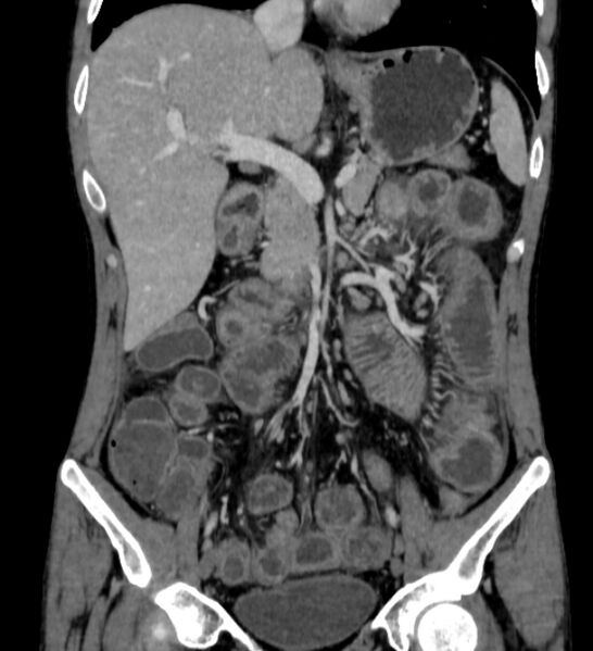 File:Behçet's disease- abdominal vasculitis (Radiopaedia 55955-62570 B 23).jpg