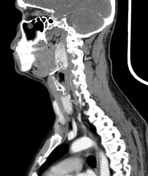 File:Bilateral carotid body tumors (Radiopaedia 52899-58827 C 34).jpg