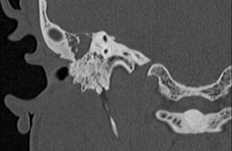File:Bilateral cholesteatoma (Radiopaedia 54898-61172 Coronal bone window 50).jpg