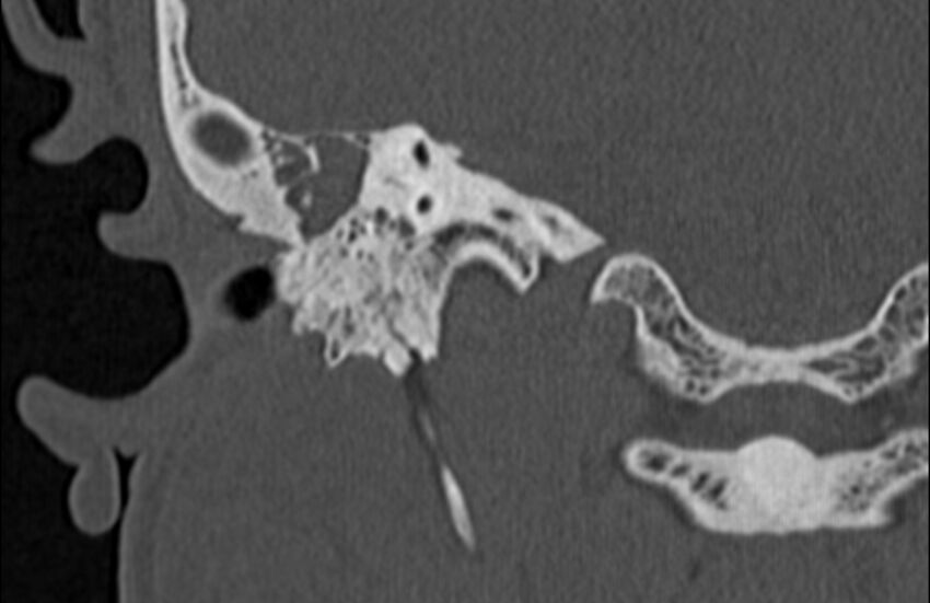 Bilateral cholesteatoma (Radiopaedia 54898-61172 Coronal bone window 50).jpg