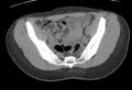 Bilateral mature cystic ovarian teratoma (Radiopaedia 88821-105592 Axial non-contrast 3).jpg