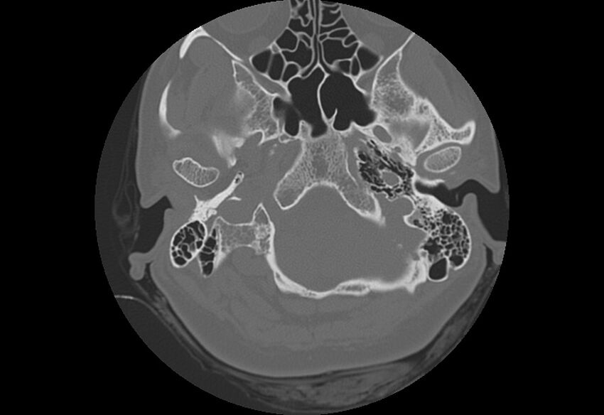 Bilateral otospongiosis (Radiopaedia 35447-36940 Axial bone window 10).jpg