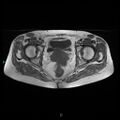 Bilateral ovarian fibroma (Radiopaedia 44568-48293 Axial T1 20).jpg