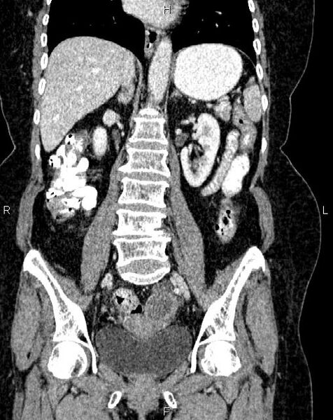 File:Bilateral ovarian serous cystadenocarcinoma (Radiopaedia 86062-101989 D 28).jpg