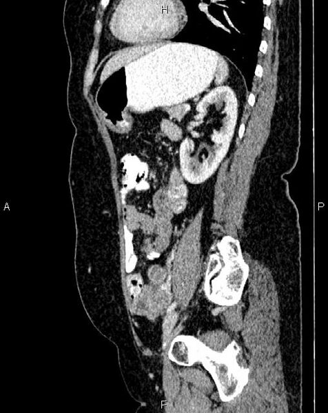 File:Bilateral ovarian serous cystadenocarcinoma (Radiopaedia 86062-101989 E 60).jpg