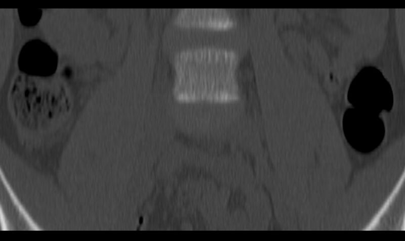 File:Bilateral pars defect (Radiopaedia 26691-26846 Coronal bone window 7).jpg