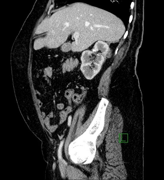 File:Bilateral sporadic synchronous clear cell renal cell carcinoma (Radiopaedia 85035-100575 G 79).jpg