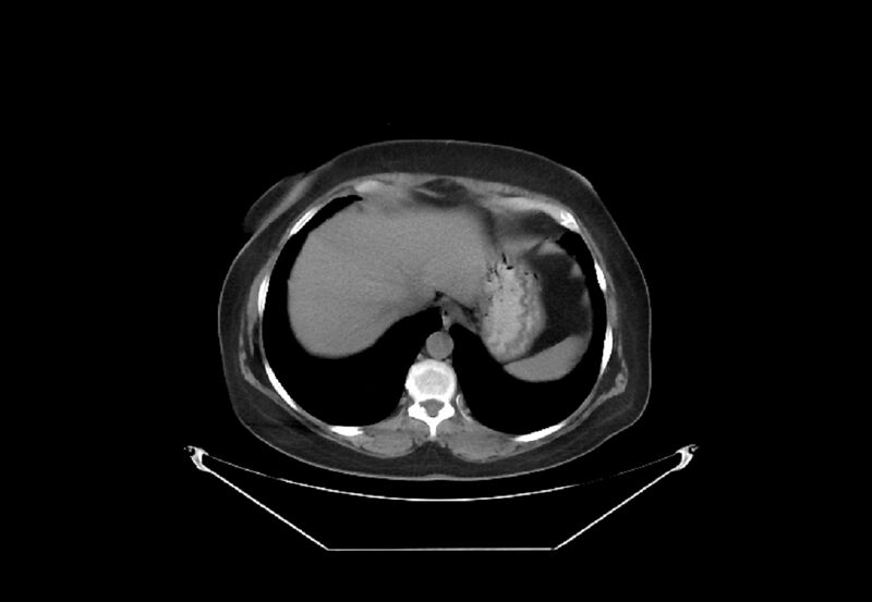 File:Bilateral urolithiasis with incidentally detected splenic artery aneurysm and left inferior vena cava (Radiopaedia 44467-48123 Axial non-contrast 1).jpg