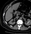 Bile leak from accessory duct(s) of Luschka post cholecystectomy (Radiopaedia 40736-43389 A 39).jpg