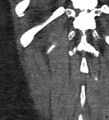 Bile leak from accessory duct(s) of Luschka post cholecystectomy (Radiopaedia 40736-43389 B 70).jpg