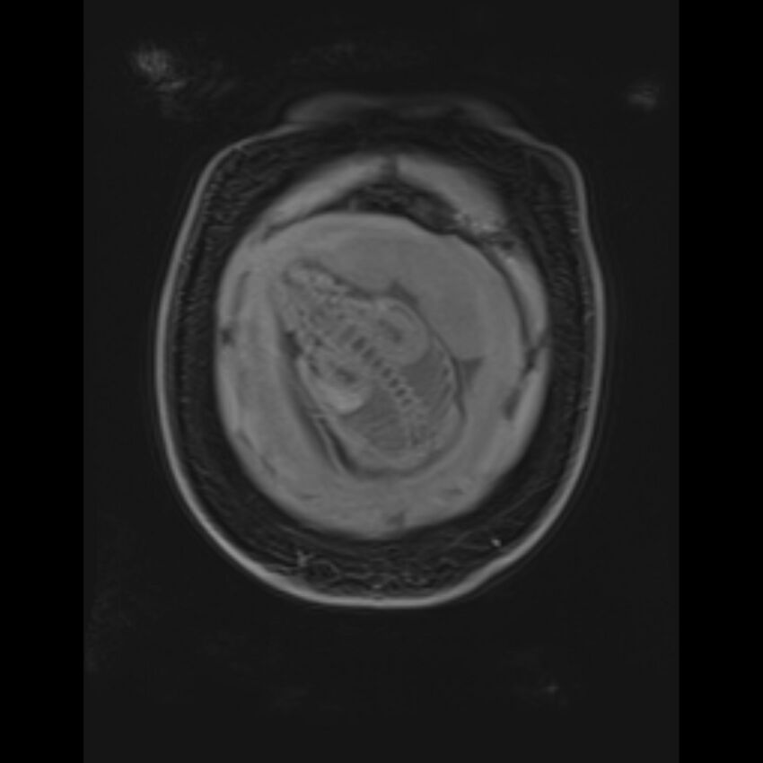 Bilobed placenta accreta (Radiopaedia 69648-79591 Coronal T1 vibe 23).jpg